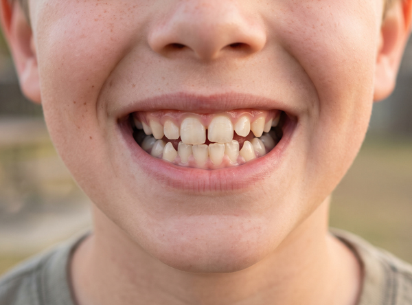 Child who needs orothodontic diagnostics